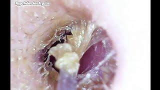 Ear Wax Removal 108 Wet And Sticky Earwax Causes Itching  Ear Cleaning ASMR Relaxing Video [upl. by Baldridge]