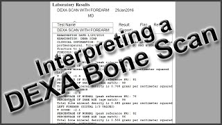 Interpreting a DEXA Bone Scan [upl. by Shell]