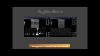 DVT Ultrasound Augmentation Technique [upl. by Kinzer]