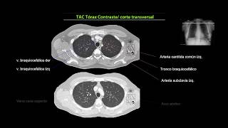 Anatomía  Imagenología Tórax [upl. by Thaxter]
