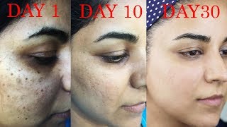 How I Got Rid of Dark Scars Hyperpigmentation PimplesAcne [upl. by Ehc297]