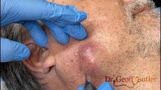 Drainage of an infected cyst along the jaw line [upl. by Towny48]