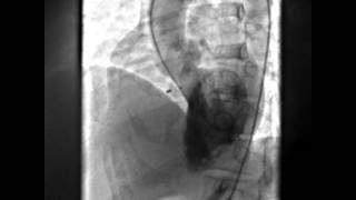 Perimembranous VSD device closure with Symmetrical Perimembranous VSD Occluder PMVSDO [upl. by Joiner921]