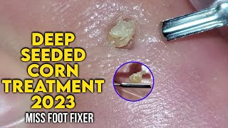 2023  Podiatrist Removes Painful Deep Seeded Corn From Sole Of Feet  MISS FOOT FIXER [upl. by Rickard]