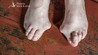 What is the best approach for bunion surgery [upl. by Janice470]