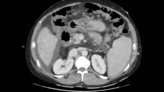 portal enteropathy [upl. by Vivian297]