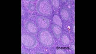 Florid follicular lymphoid hyperplasia [upl. by Enilrac]