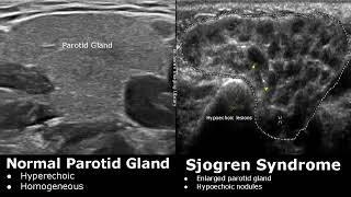 Salivary Glands Ultrasound Normal Vs Abnormal Images  Parotid Submandibular amp Sublingual Gland USG [upl. by Orelu965]