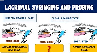 Lacrimal Syringing and Probing  Technique and Interpretation of results [upl. by Imojean]