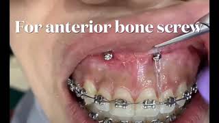 Orthodontic Mechanics used for the intrusion of the maxillary dentition [upl. by Aniez]