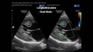 Subvalvular aortic stenosis in a cat [upl. by Ferullo]