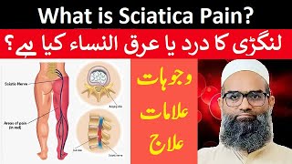 What is Sciatica Pain  Langri Ka Dard  Arqun Nisa  Causes Symptoms and Treatment  Urdu  Hindi [upl. by Alf]