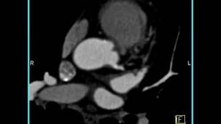 Cardiac extensive calcifications in the LAD 4of 4 [upl. by Mort]