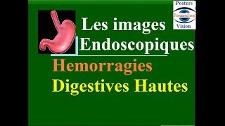 Les images endoscopiques et causes des hémorragies digestive hautes fibroscopie gastrique endoscopie [upl. by Elinor]