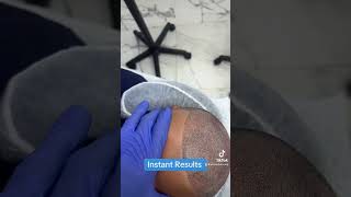 Scalp micro pigmentation For free consultation send pictures at 9546045882 [upl. by Cinimmod403]