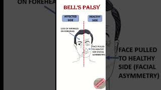 Bells Palsy dentaleducation educationalvideo neetmds dental dentalhealth bds bdshorts [upl. by Lifton]