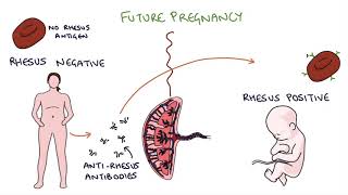 Understanding Rhesus Status and AntiD in Pregnancy [upl. by Atterrol]