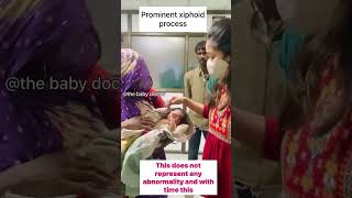 Prominent xiphoid process in newborn the baby doctor newborn babyvideos ytshorts viralvideo [upl. by Latsyc868]