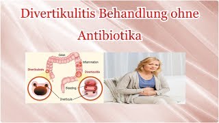 Divertikulitis Behandlung ohne Antibiotika [upl. by Serena798]