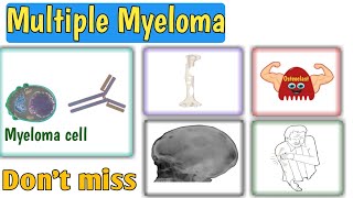 Multiple Myeloma  Causes  Pathophysiology  Signs amp symptoms  Diagnosis  Treatment [upl. by Deer310]