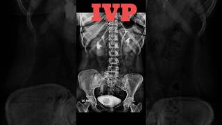 IVP  Intravenous pyelography shorts ivp specialcase radiology radiologyjunction [upl. by Yzdnil]