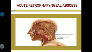 Acute and chronic retropharyngeal abscess [upl. by Mcgannon]