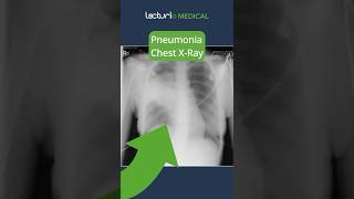 Understanding Lobar Pneumonia 🫁 MedicalEducation usmle [upl. by Sabra335]