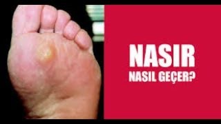 NASIR TEDAVİSİ NASIL YAPILIR NASIR BİR GÜNDE NASIL GEÇER [upl. by Eekorehc664]