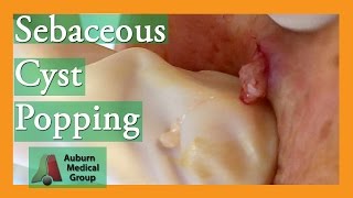 Epidermoid Cyst Popping popping  Auburn Medical Group [upl. by Gilberto]