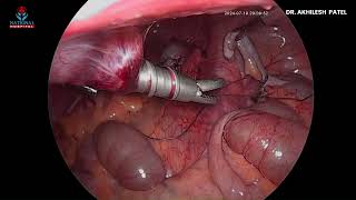 laproscopic appendectomy [upl. by Lesna]