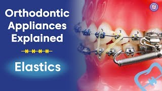 Orthodontic Appliances Explained  Elastics [upl. by Jablon917]