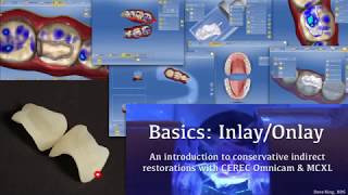 Basics of Inlays and Onlays  Conservative Indirect Restoration with CEREC Omnicam and MCXL [upl. by Annuaerb77]