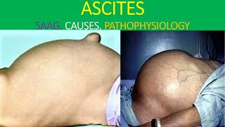 Ascites analysis explained [upl. by Hollister828]