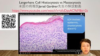 Langerhans cell histiocytosisの病理組織像の解説 [upl. by Finnigan667]