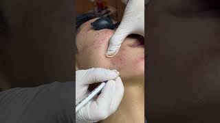 Blackhead removal No66 diidiibeautyspa blackhead acne [upl. by Sesiom867]