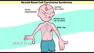 Gorlin syndrome nevoid basal cell carcinoma syndrome  Mnemonic  easy learning [upl. by Yrocal]