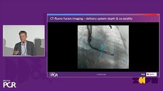 Transformative imaging in the clinical pathway of transcatheter tricuspid valve interventions [upl. by Acnayb]