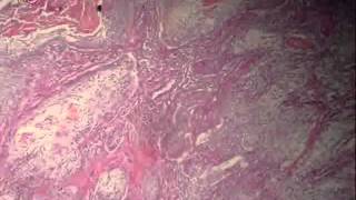 Bronchogenic carcinoma عملي عبد الرحمن خليفة [upl. by Wylma135]