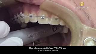 Operculectomy with LiteTouch™ ErYAG laser [upl. by Manwell243]