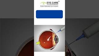 How is Diabetic Retinopathy treated  Eye care Hyderabad  Retina Specialist [upl. by Ahsikal51]