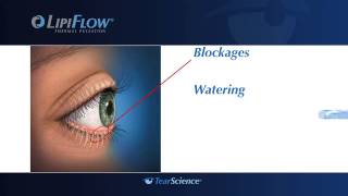 Meibomian Gland Dysfunction and Evaporative Dry Eye Patient Video Short [upl. by Ikkiv]