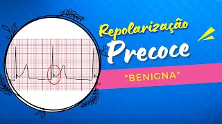 Repolarização Precoce quotBenignaquot [upl. by Madora526]