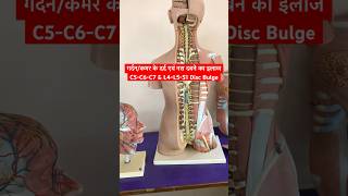 Cervical Problem amp Lower Back Pain Treatment shorts sciatica neckpain [upl. by Kcirtap]