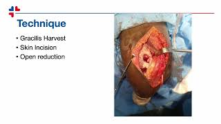 A Neglected elbow dislocation managed with Ligament Reconstruction [upl. by Beaulieu935]