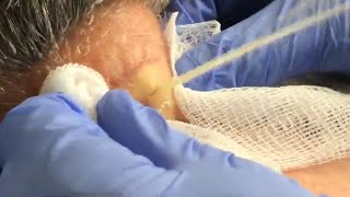 Large Cyst Squirts and Oozes from Patients Neck [upl. by Ahseuqram945]