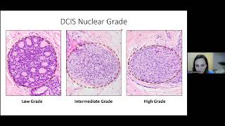 Lobular Carcinoma in Situ Displays Intralesion Genetic Heterogeneity [upl. by Eniledam]