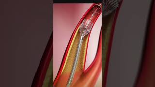 एंजियोप्लास्टी में स्टेंट कैसे लगाते है Angioplasty Stent Insertion Tutorial  StepbyStep Guide [upl. by Idoux]