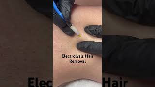 Electrolysis Hair Removal [upl. by Iseabal]