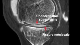 Chondropathie fémorotibiale et Arthroscanner [upl. by Ettennaj]