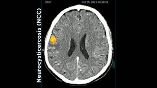 Neuro cysticercosis NCC drarupkarmakar ArupKarmakar reels NeuroCysticercosis [upl. by Arrad]